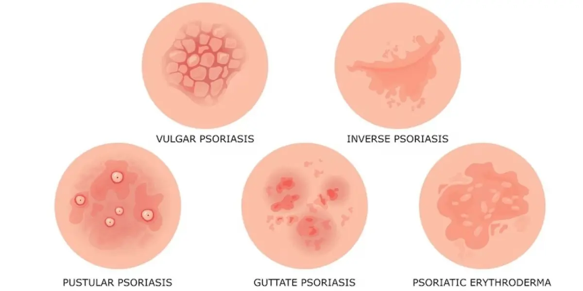 Plaque Psoriasis: An In-depth Exploration