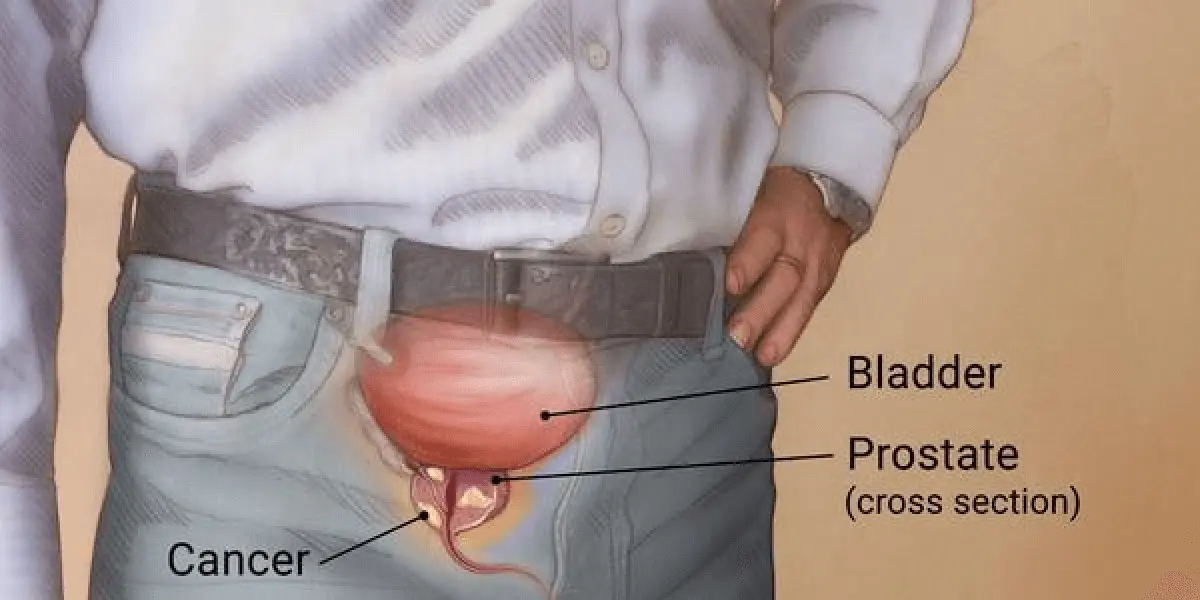 Understanding Prostate Cancer: A Patient’s Guide